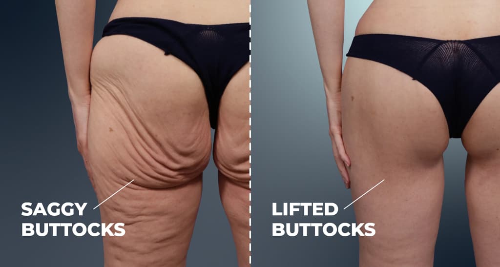 Before and after image of saggy buttocks versus lifted buttocks