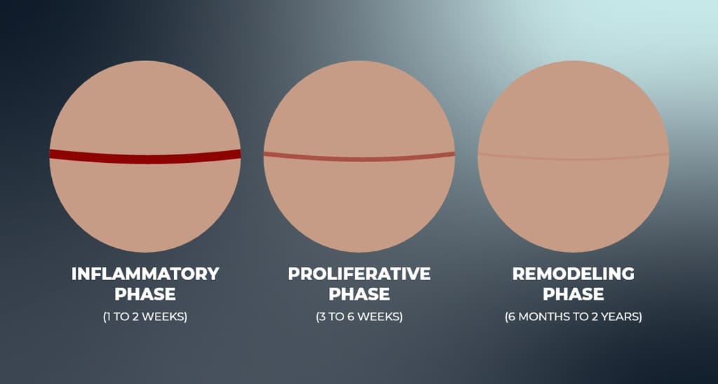 Timeline image depicting different phases of healing: Inflammatory phase, proliferative phase, remodeling phase