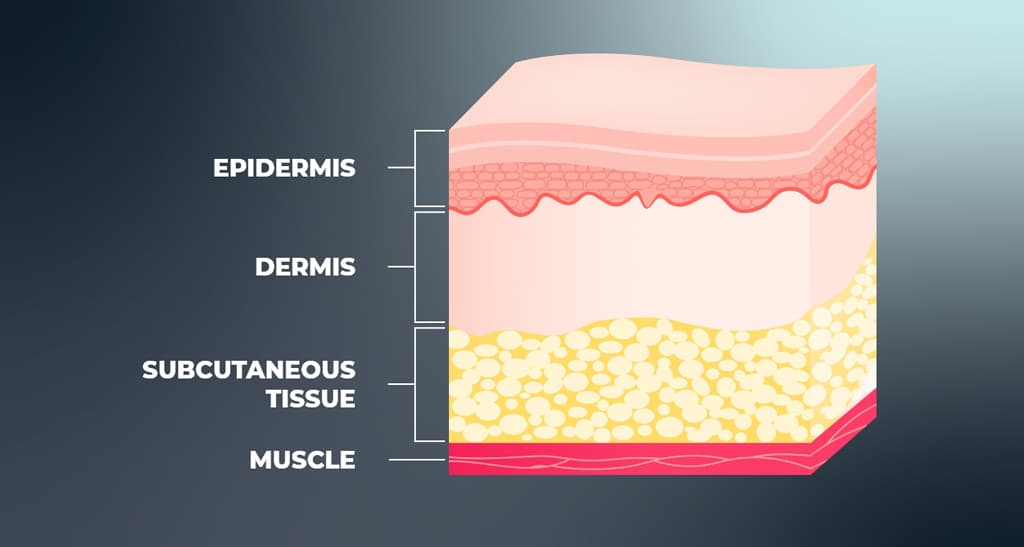 Illustration of the skin layer: Epidermis, Dermis, Subcutaneous Tissue, Muscle
