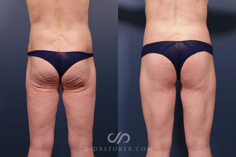 Bikini Body Lift: Before and After