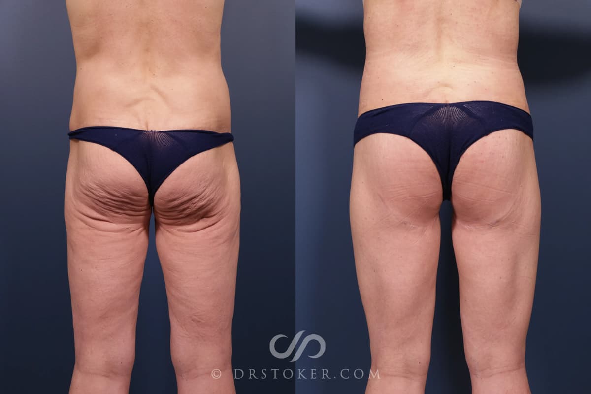Bikini Body Lift: Before and After