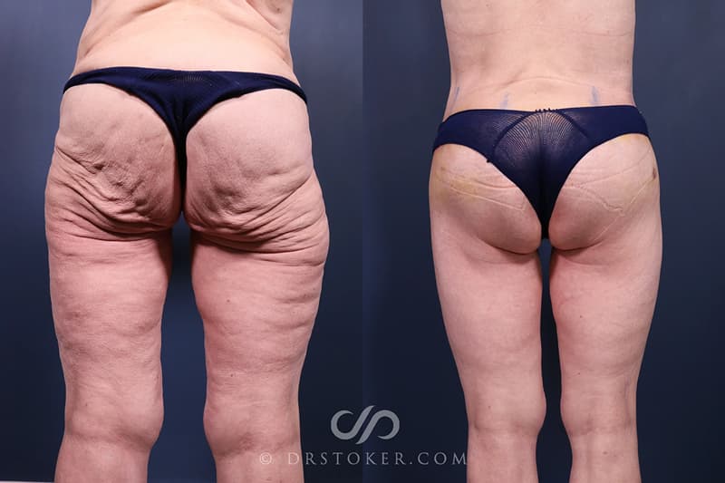 Bikini Body Lift: Before and After