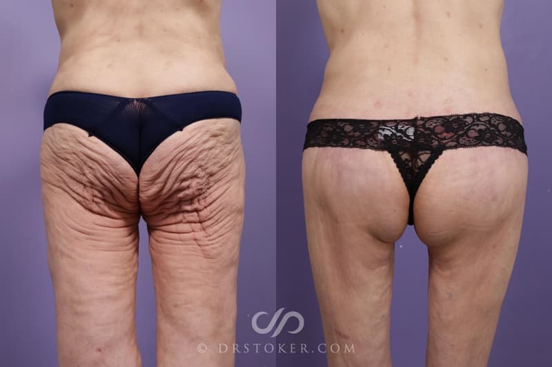 Bikini Body Lift: Before and After