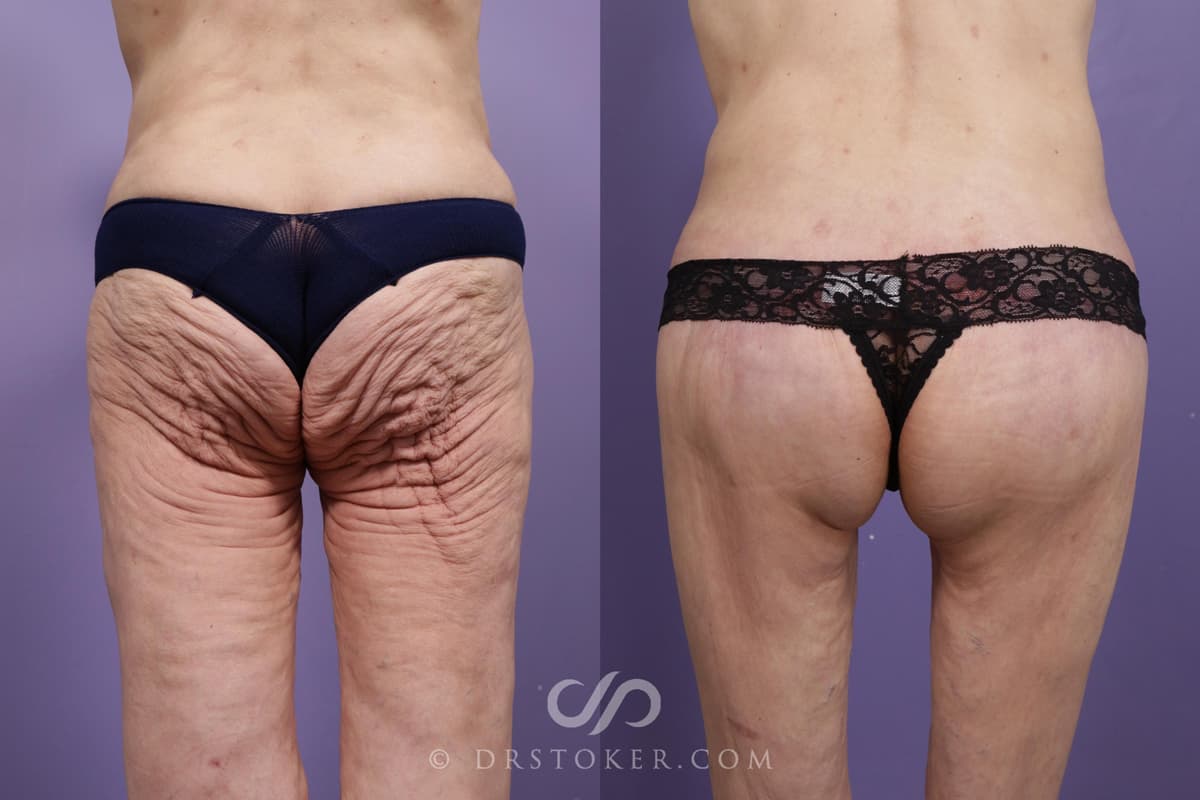 Bikini Body Lift: Before and After