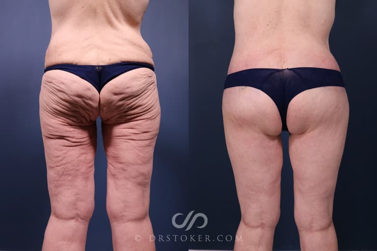 Bikini Body Lift ™ Before & After