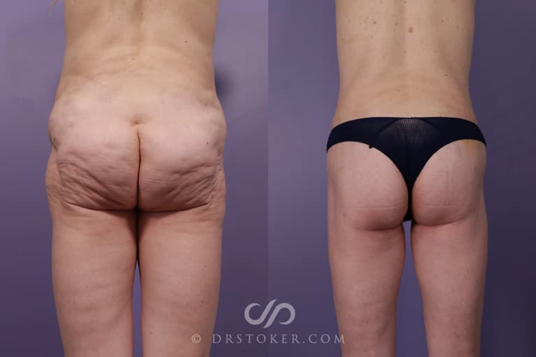 Bikini Body Lift ™ Before & After