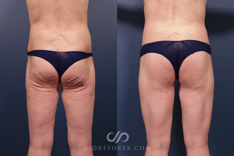 Bikini Body Lift ™ Before & After