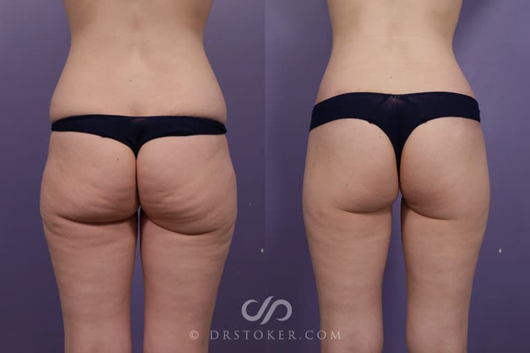 Bikini Body Lift ™ Before & After