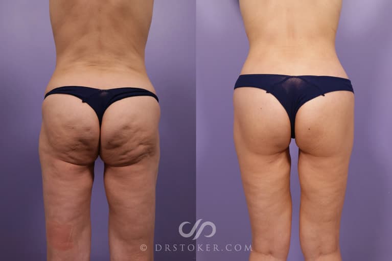 Bikini Body Lift ™ Before & After