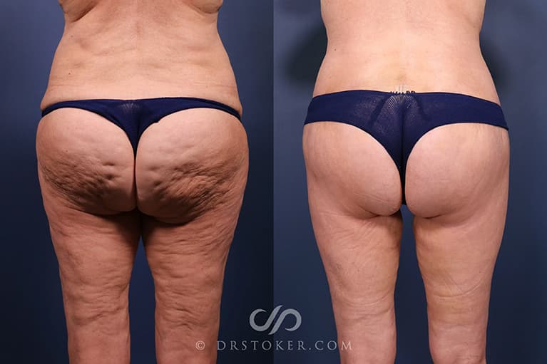 Bikini Body Lift ™ Before & After