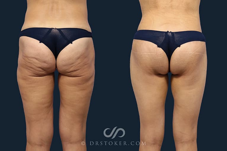 Bikini Body Lift ™ Before & After