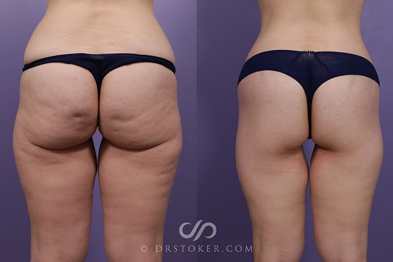 Bikini Body Lift ™ Before & After
