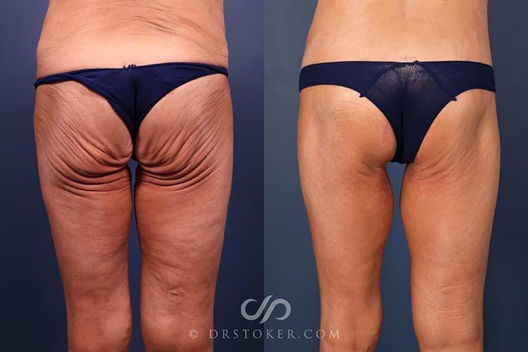 Bikini Body Lift ™ Before & After