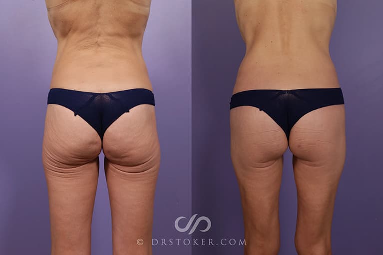 Bikini Body Lift ™ Before & After