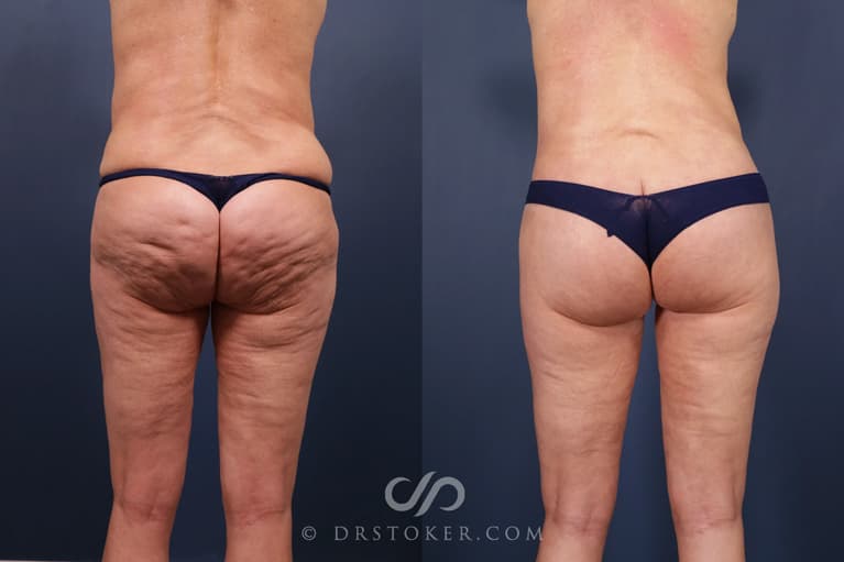 Bikini Body Lift ™ Before & After