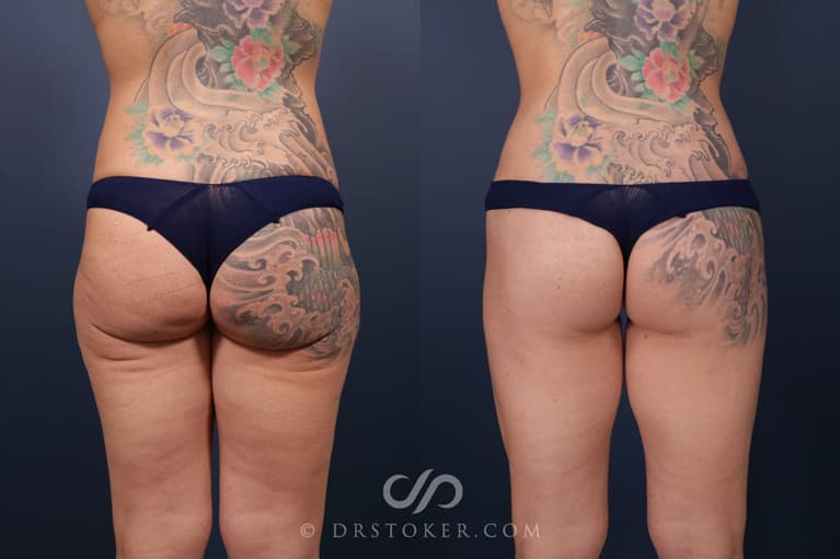 Bikini Body Lift ™ Before & After