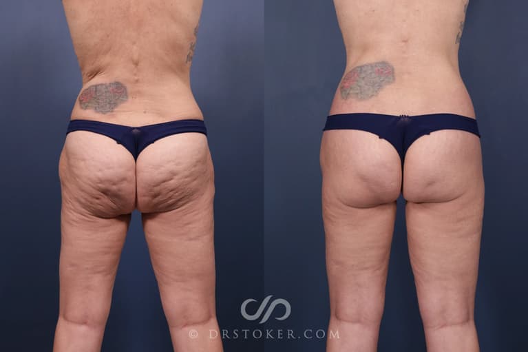 Bikini Body Lift ™ Before & After