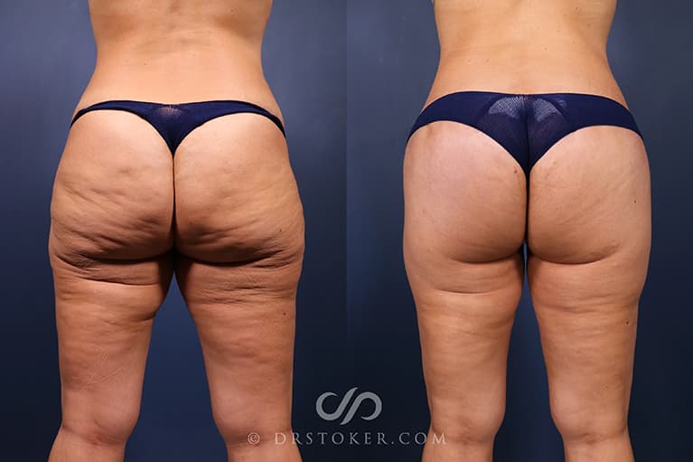 Bikini Body Lift ™ Before & After