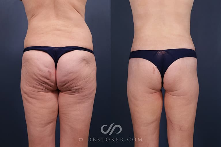 Bikini Body Lift ™ Before & After