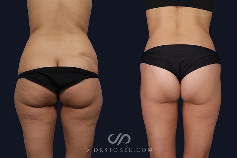 Bikini Body Lift ™ Before & After