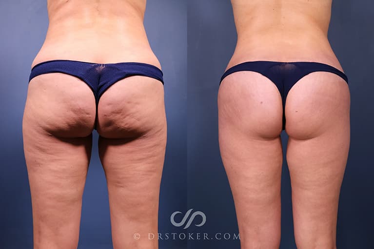 Bikini Body Lift ™ Before & After