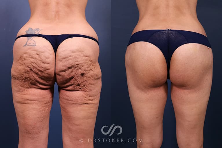 Bikini Body Lift ™ Before & After